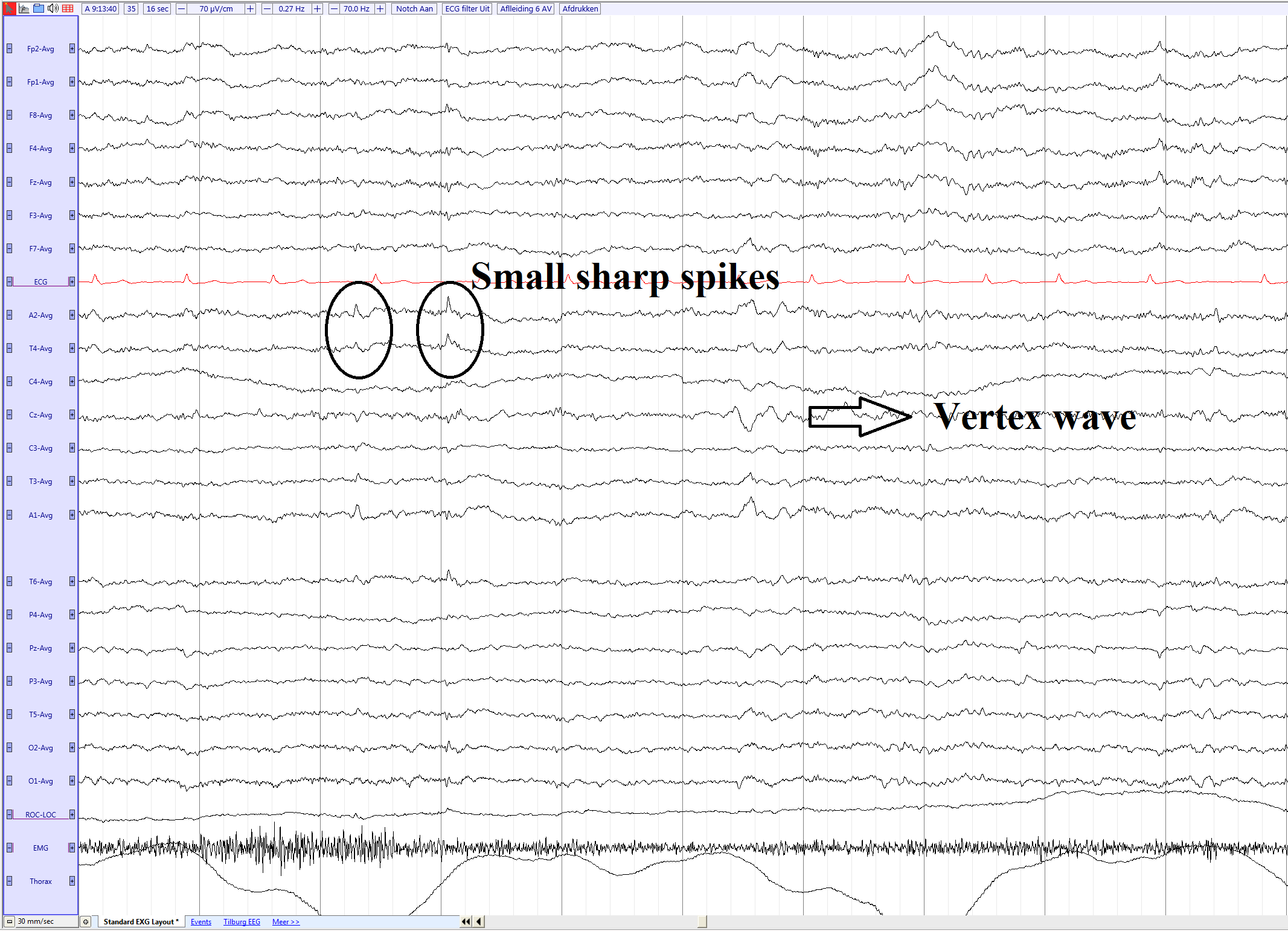 Small sharp spikes (SSS or BETS) EEGpedia