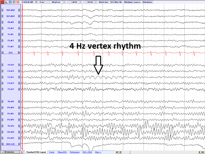 File:4 Hz vertex rhythm (source) eegpedia.png