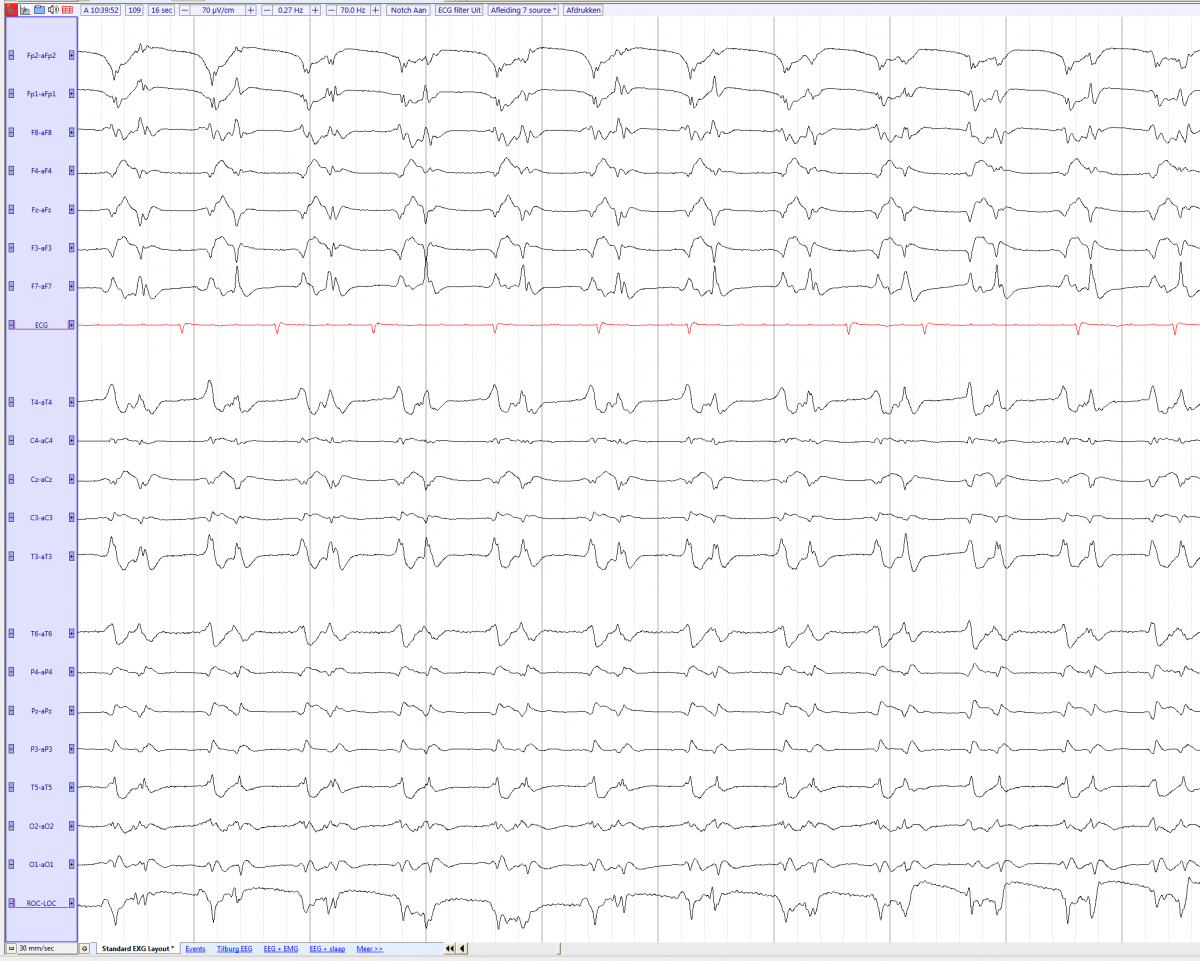 GPD in a 85 years old male after a out of hospital cardiac arrest.png