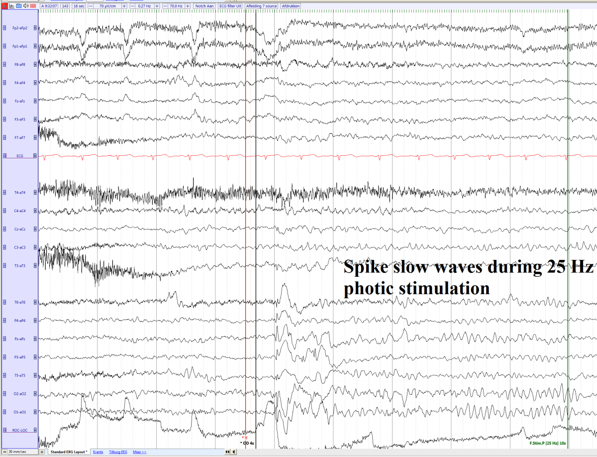 Waltz 2 photoparoxysmal respons in a 11 year old girl (EEGpedia).png