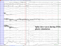 Waltz 2 photoparoxysmal respons in a 11 year old girl (EEGpedia).png