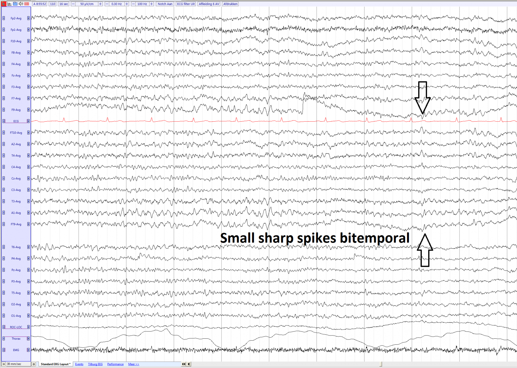 small-sharp-spikes-sss-of-bets-eegpedia