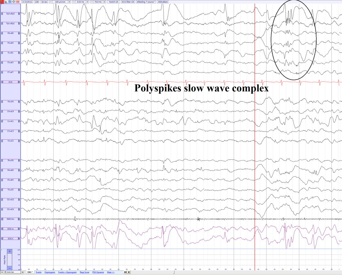 Polyspikes slow wave complex in a 6 year old girl wiht Rett syndrome (source).png