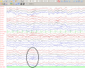 14 Hz positive burst in a 7 years old girl during NREM 1 sleep.png