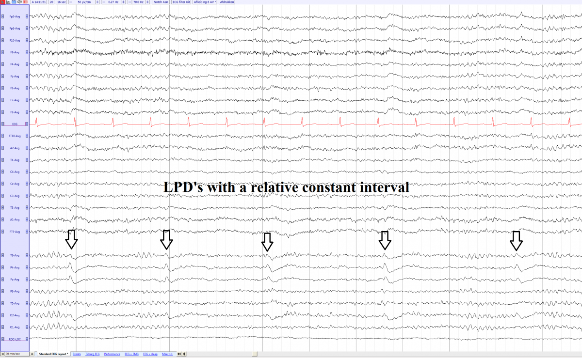 LPD's left parieto occipital male 78 yo with a hemmorrhage left occipital (average).png