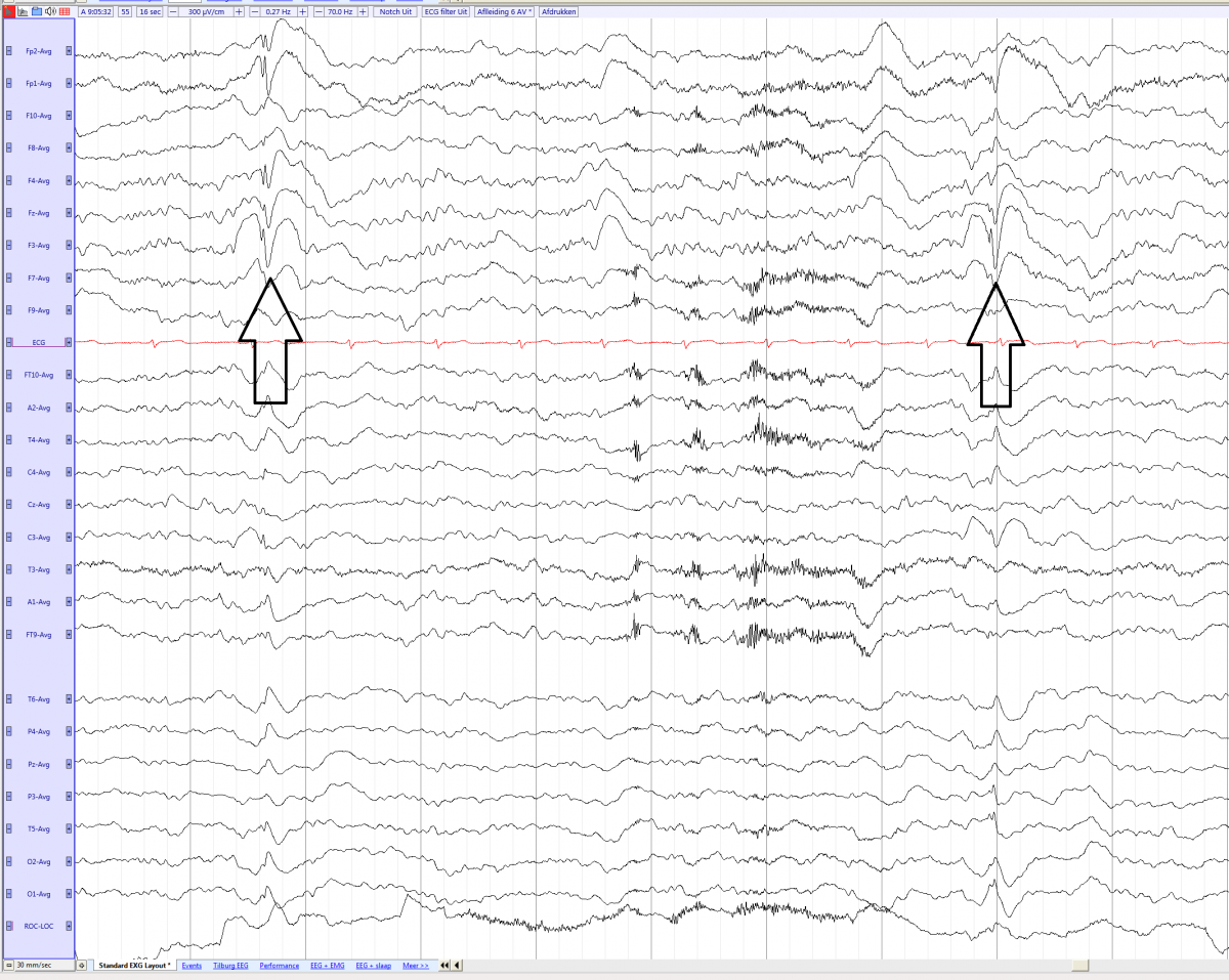 Spike slow wave complex in a boy 12 years old (average).png