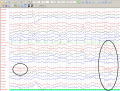 6 Hz positive burst in a 6 years old boy EEGpedia.png