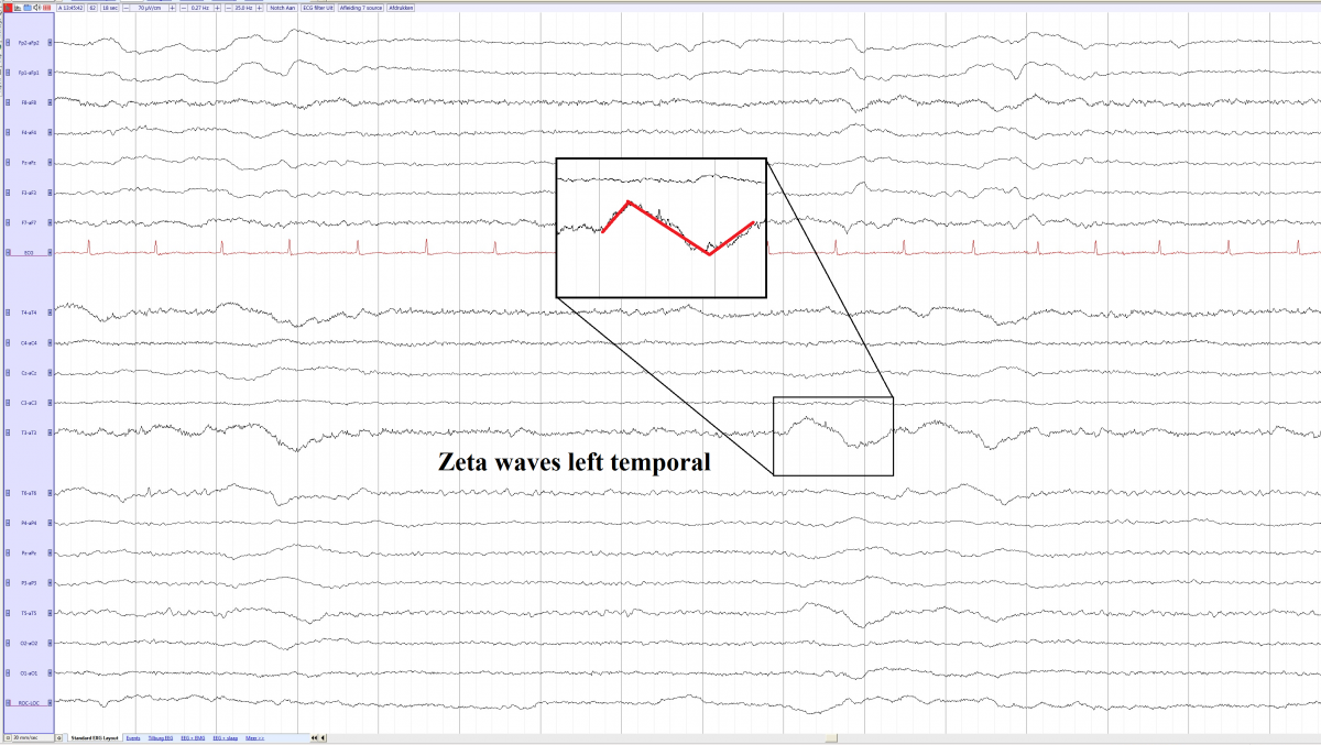 Zeta waves left temporal in a 77 year old female with a infarction left temporal (source).png