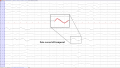 Zeta waves left temporal in a 77 year old female with a infarction left temporal (source).png