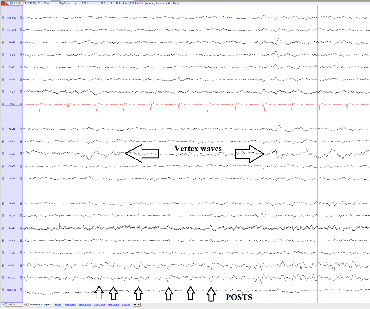 POSTS (Positive occipital sharp transients of sleep) EEGpedia