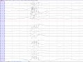 Juvenile myoclonic epilepsy in a 15 year old male (source) EEGpedia.png