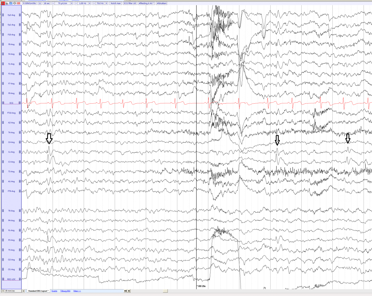 Rolandic epilepsy in a 7 year old girl (average) EEGpedia.png