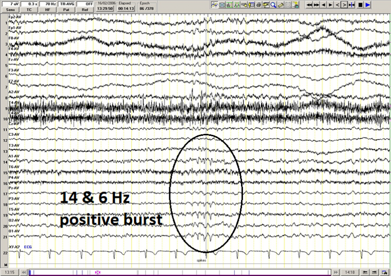 File:14 & 6 Hz positive bursts (average).png